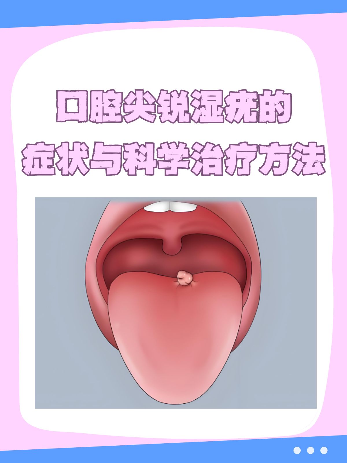 尖锐湿疣怎么治疗才能根治口腔_(尖锐湿疣怎么治疗才能根治口腔溃疡) 尖锐湿疣怎么治疗才能根治口腔_(尖锐湿疣怎么治疗才能根治口腔溃疡)