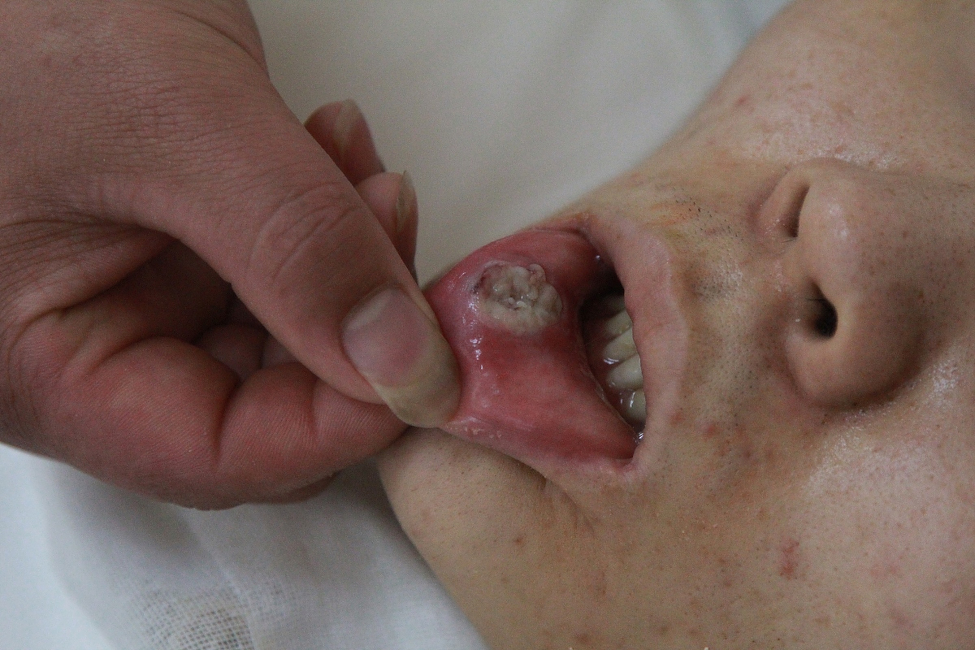 尖锐湿疣怎么治疗才能根治口腔_(尖锐湿疣怎么治疗才能根治口腔溃疡) 尖锐湿疣怎么治疗才能根治口腔_(尖锐湿疣怎么治疗才能根治口腔溃疡)